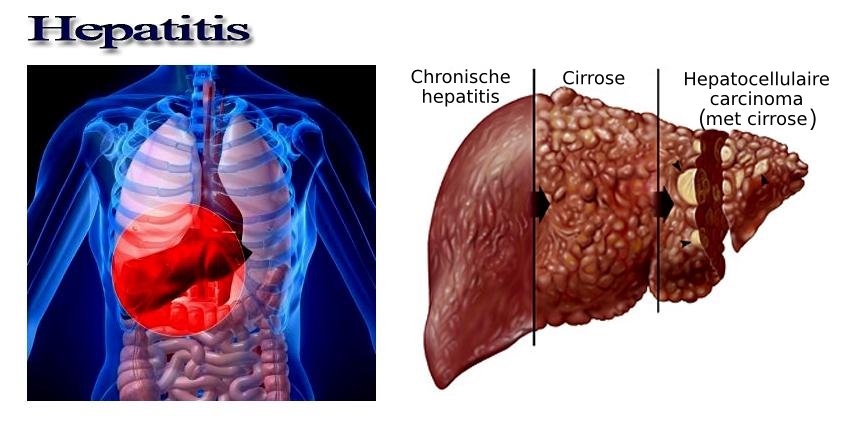 hepatitis